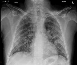Medical-Case-Reports-Chest