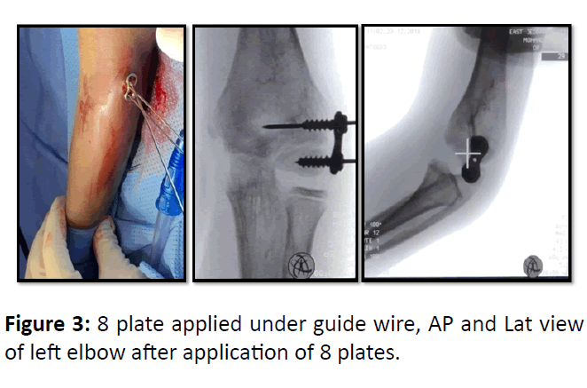 medical-case-plate-applied