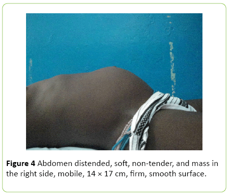 medical-case-reports-Abdomen-distended
