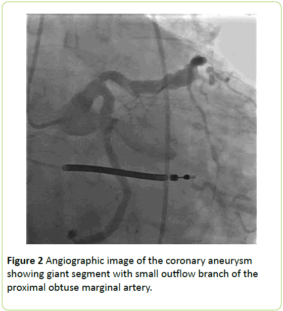 medical-case-reports-Angiographic-image-coronary