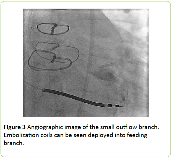 medical-case-reports-Angiographic-small-outflow