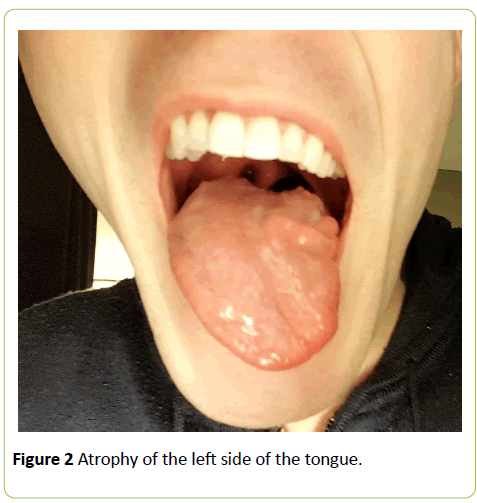 medical-case-reports-Atrophy-left-side-tongue