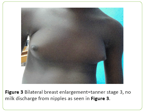 medical-case-reports-Bilateral-breast
