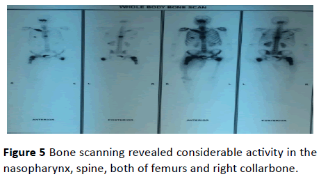 medical-case-reports-Bone-scanning