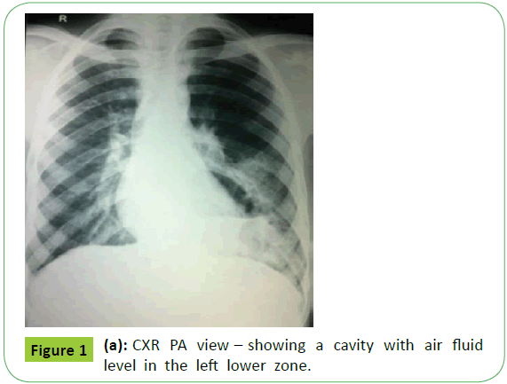 medical-case-reports-CXR-view-cavity