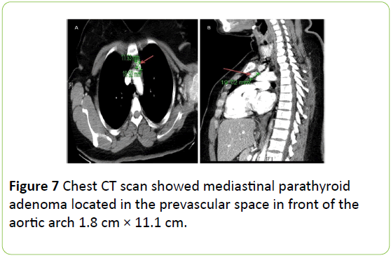medical-case-reports-Chest-mediastinal-parathyroid