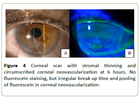 medical-case-reports-Corneal-scar