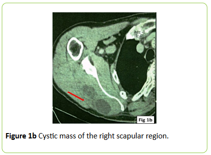 medical-case-reports-Cystic-mass-right-scapular-region