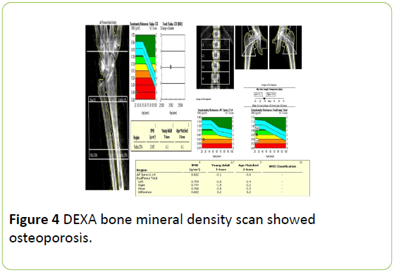 medical-case-reports-DEXA-bone-mineral