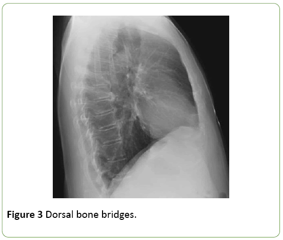 medical-case-reports-Dorsal-bone