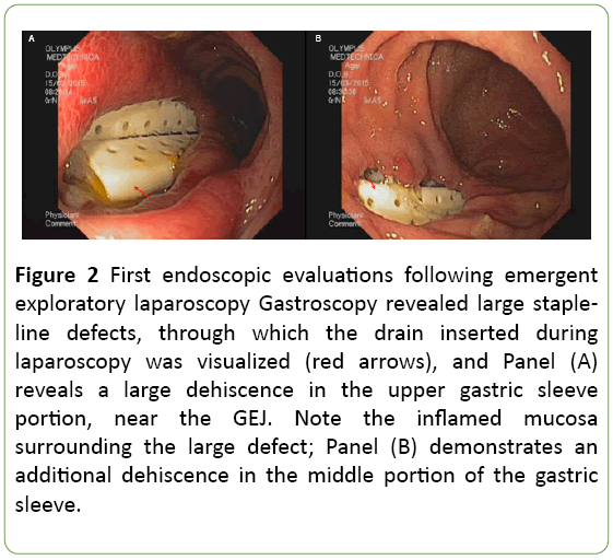 medical-case-reports-First-endoscopic