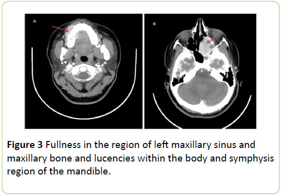medical-case-reports-Fullness-maxillary-sinus