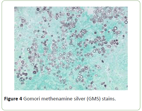 medical-case-reports-Gomori-methenamine