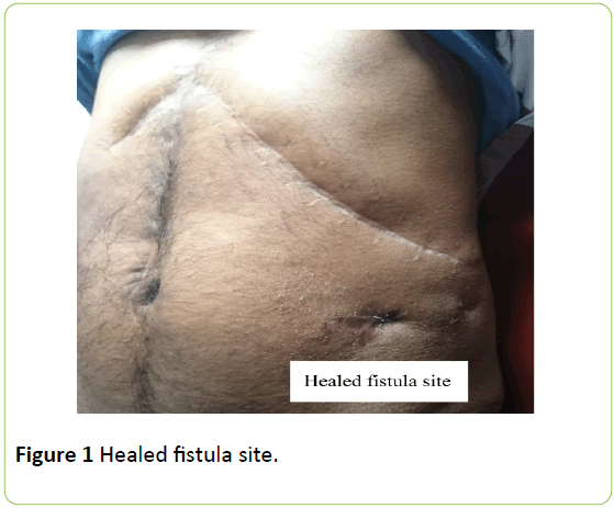 medical-case-reports-Healed-fistula-site