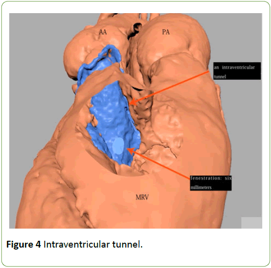 medical-case-reports-Intraventricular-tunnel