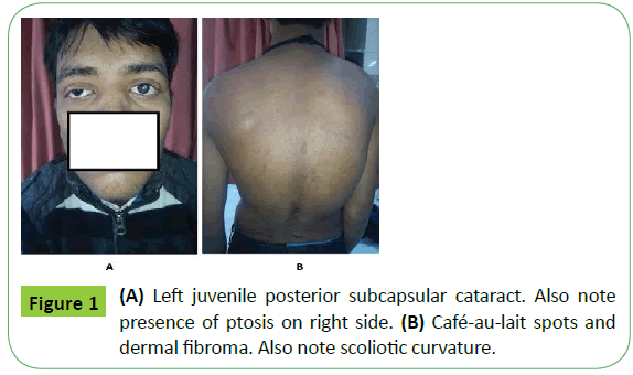medical-case-reports-Left-juvenile-posterior