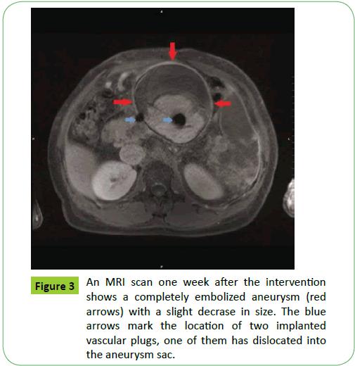 medical-case-reports-MRI-scan-embolized