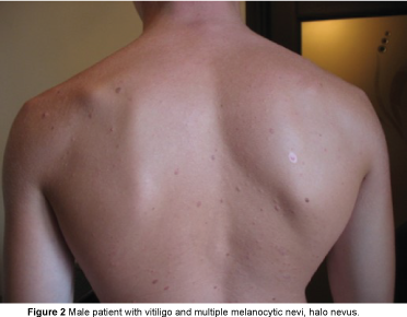 Male-patient-vitiligo
