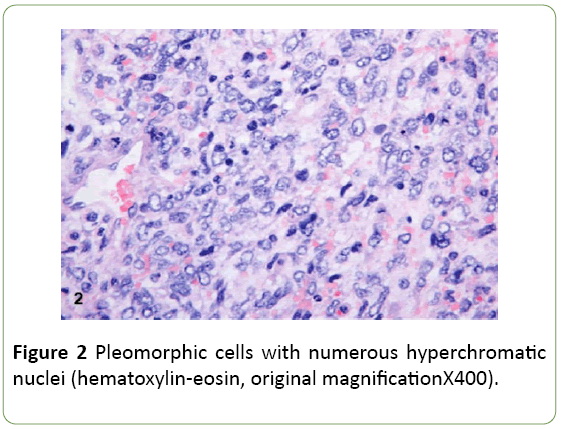 medical-case-reports-Pleomorphic-cells