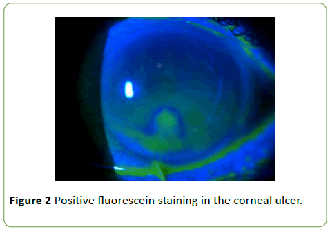 medical-case-reports-Positive-fluorescein