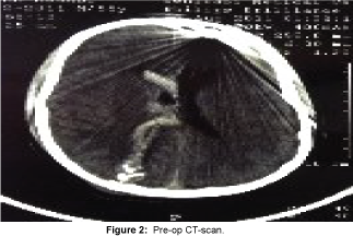 Pre-op-CT-scan