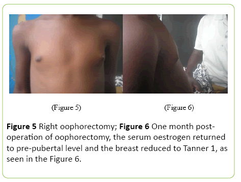 medical-case-reports-Right-oophorectomy