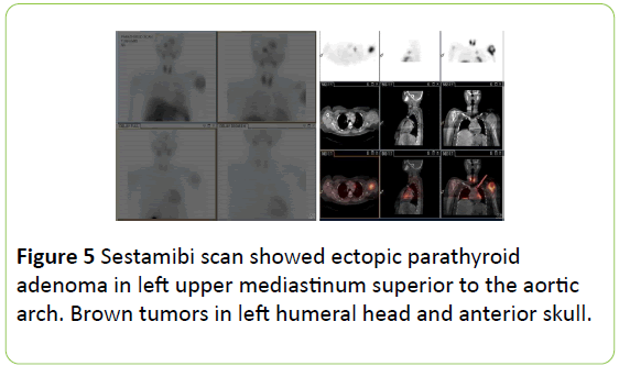 medical-case-reports-Sestamibi-scan-ectopic