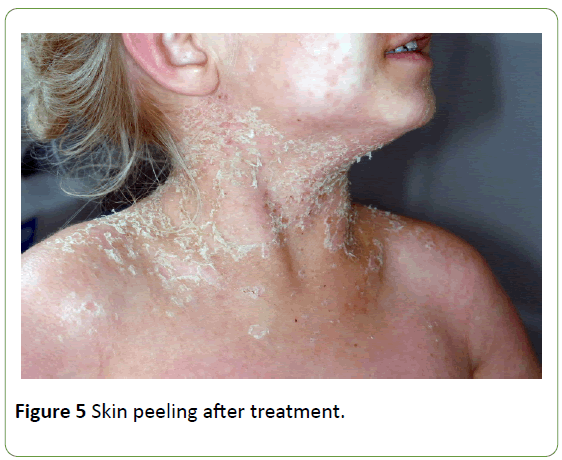 medical-case-reports-Skin-peeling