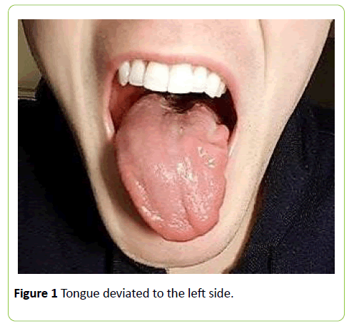 medical-case-reports-Tongue-deviated-left-side