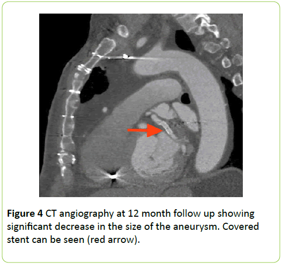 medical-case-reports-angiography-decrease-aneurysm