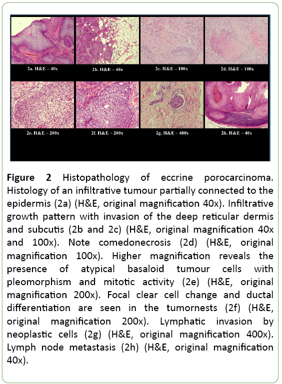 medical-case-reports-eccrine-porocarcinoma