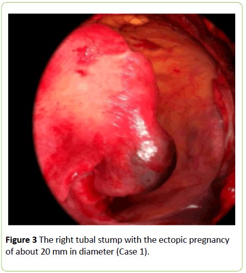 medical-case-reports-ectopic