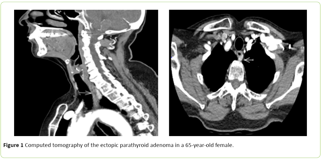 medical-case-reports-ectopic-parathyroid