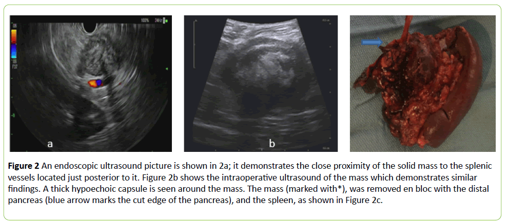 medical-case-reports-endoscopic-ultrasound-picture