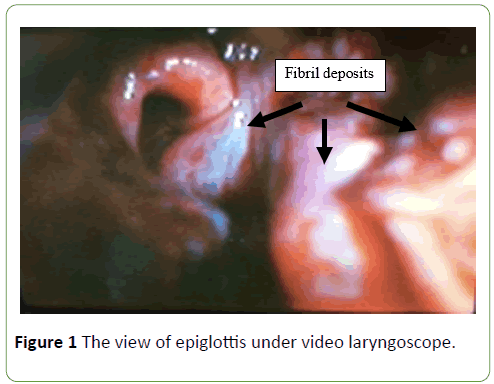 medical-case-reports-epiglottis