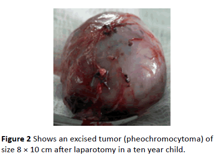 medical-case-reports-excised-tumor
