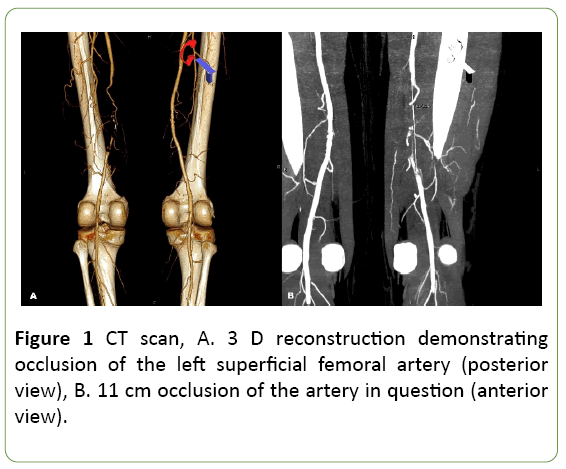 medical-case-reports-femoral-artery