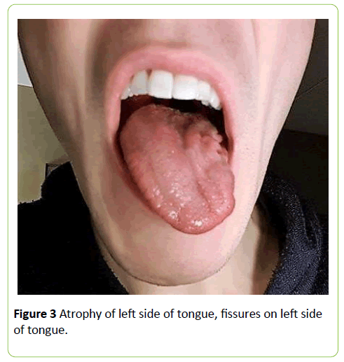 medical-case-reports-fissures-left-side-tongue