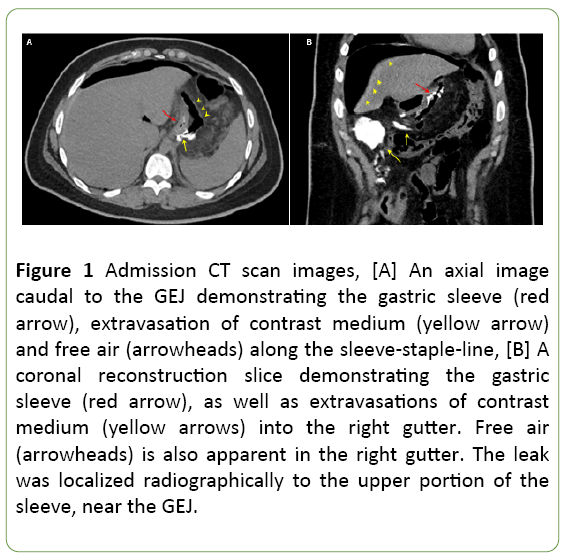 medical-case-reports-gastric-sleeve