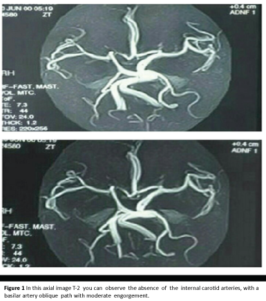 internal-carotid-arteries