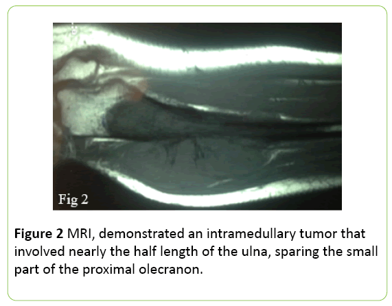 medical-case-reports-intramedullary-tumor