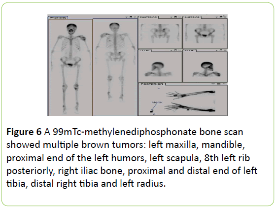 medical-case-reports-methylenediphosphonate-bone-scan
