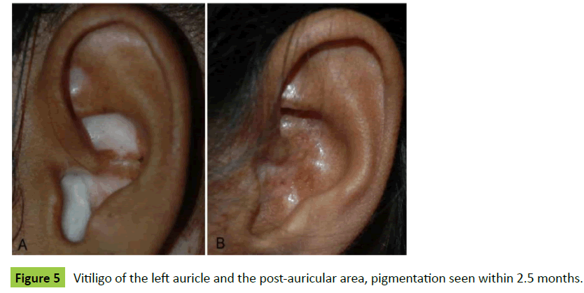 medical-case-reports-post-auricular