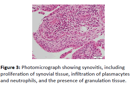 medical-case-reports-proliferation-synovial-tissue