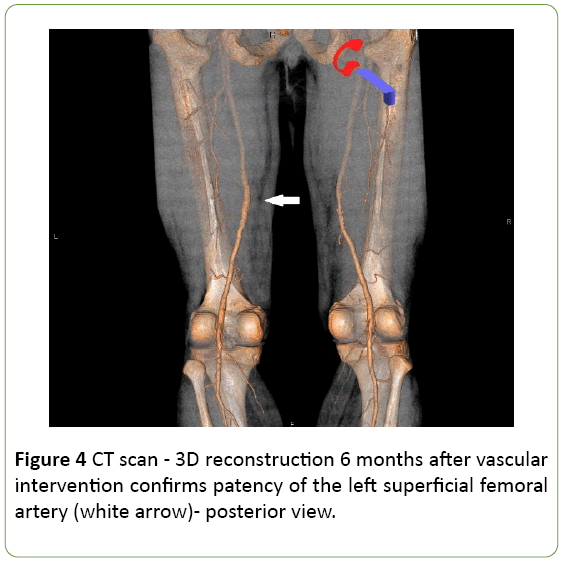 medical-case-reports-superficial-femoral