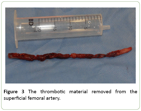 medical-case-reports-thrombotic-material