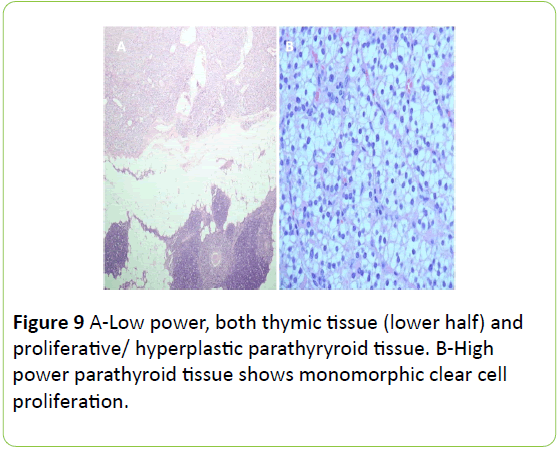 medical-case-reports-thymic-hyperplastic-parathyryroid