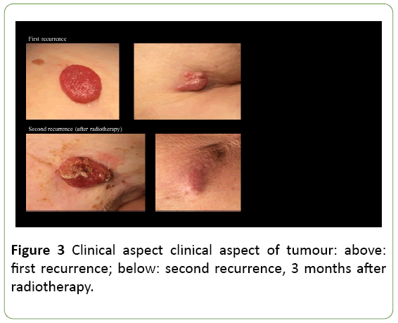 medical-case-reports-tumour-recurrence