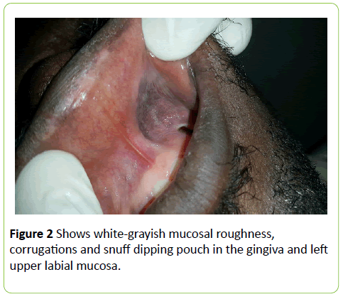 medical-case-reports-white-grayish-mucosal-roughness-corrugations